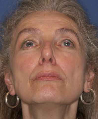 Nasenflügelkollaps bds. nach auswärtiger Nasenoperation vor der Korrektur durch Dr. Robert Pavelka