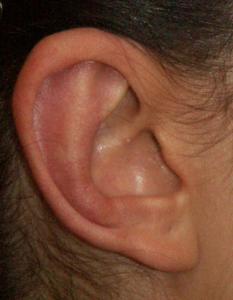 Eine natürlich gerundete Anthelixfalte in minimal-invasiver vorderer Op-Technik legt das Ohr an: 4 Monate postoperativ