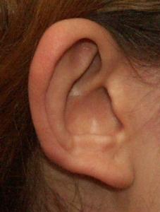 kaum ausgebildete Anthelixfalte verursacht abstehendes Ohr